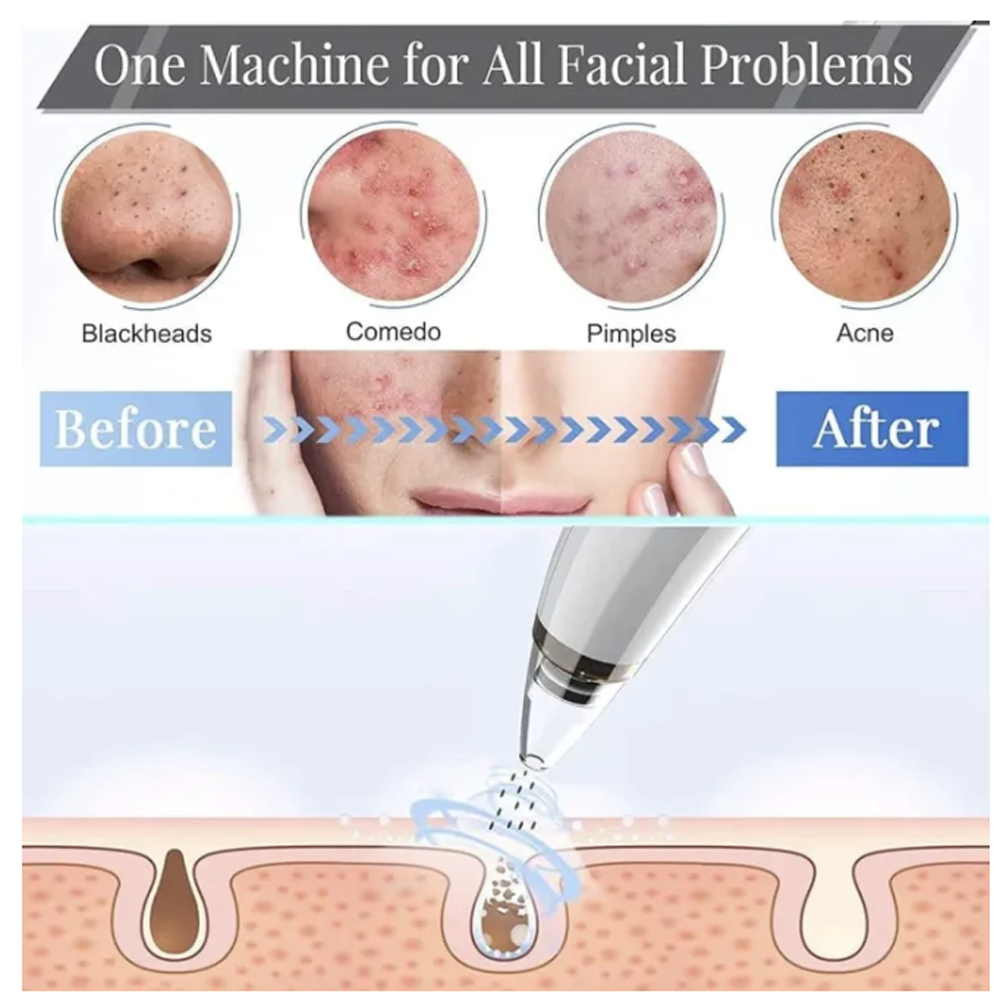Derma Suction 6 in 1 Blackhead Acne and Nose Pore Removal Machine Rechargeable